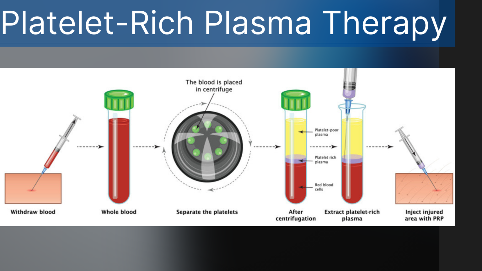 Platelet Rich Plasma (PRP)