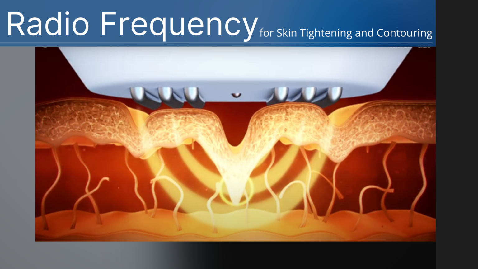 Radio Frequency Skin Tightening and Contouring