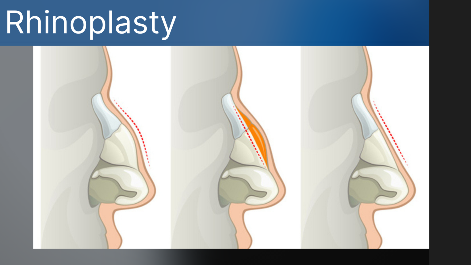 Nasal Rhinotomy Rhinoplasty